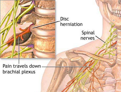 Neck and upper back pain - Female Chiropractor Singapore